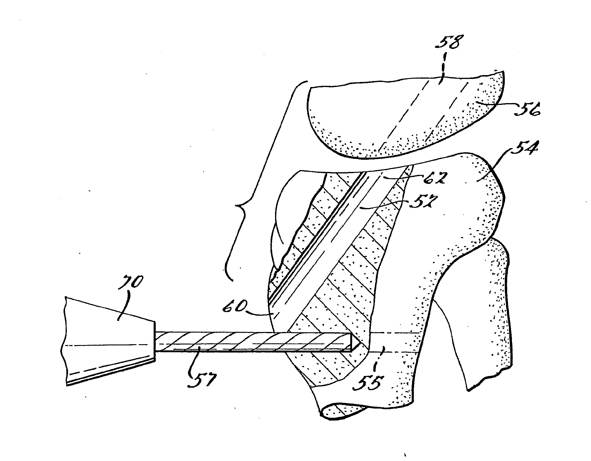 Apparatus and Method for Tibial Fixation of Soft Tissue