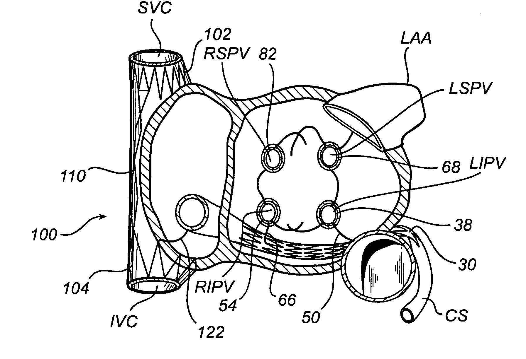 Device, a kit and a method for treatment of disorders in the heart rhythm regulation system