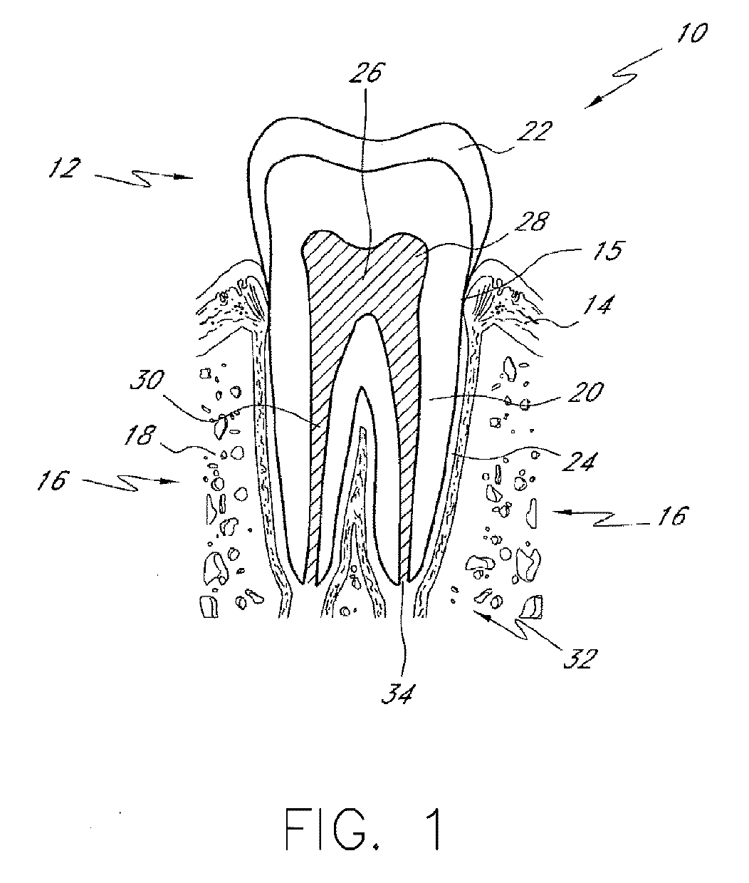 Liquid jet apparatus and methods for dental treatments