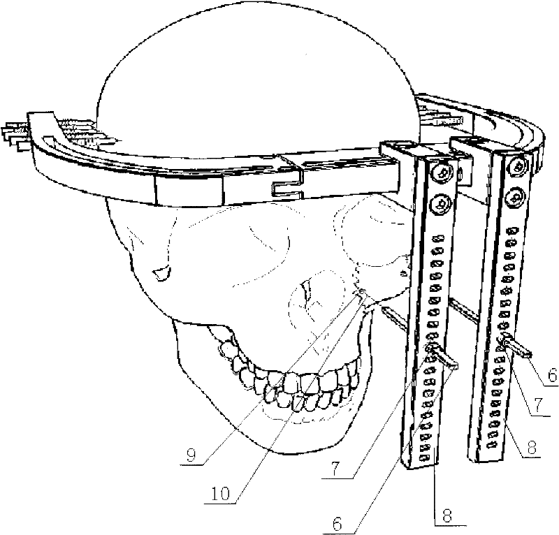 An adjustable midface bone distractor and its design method