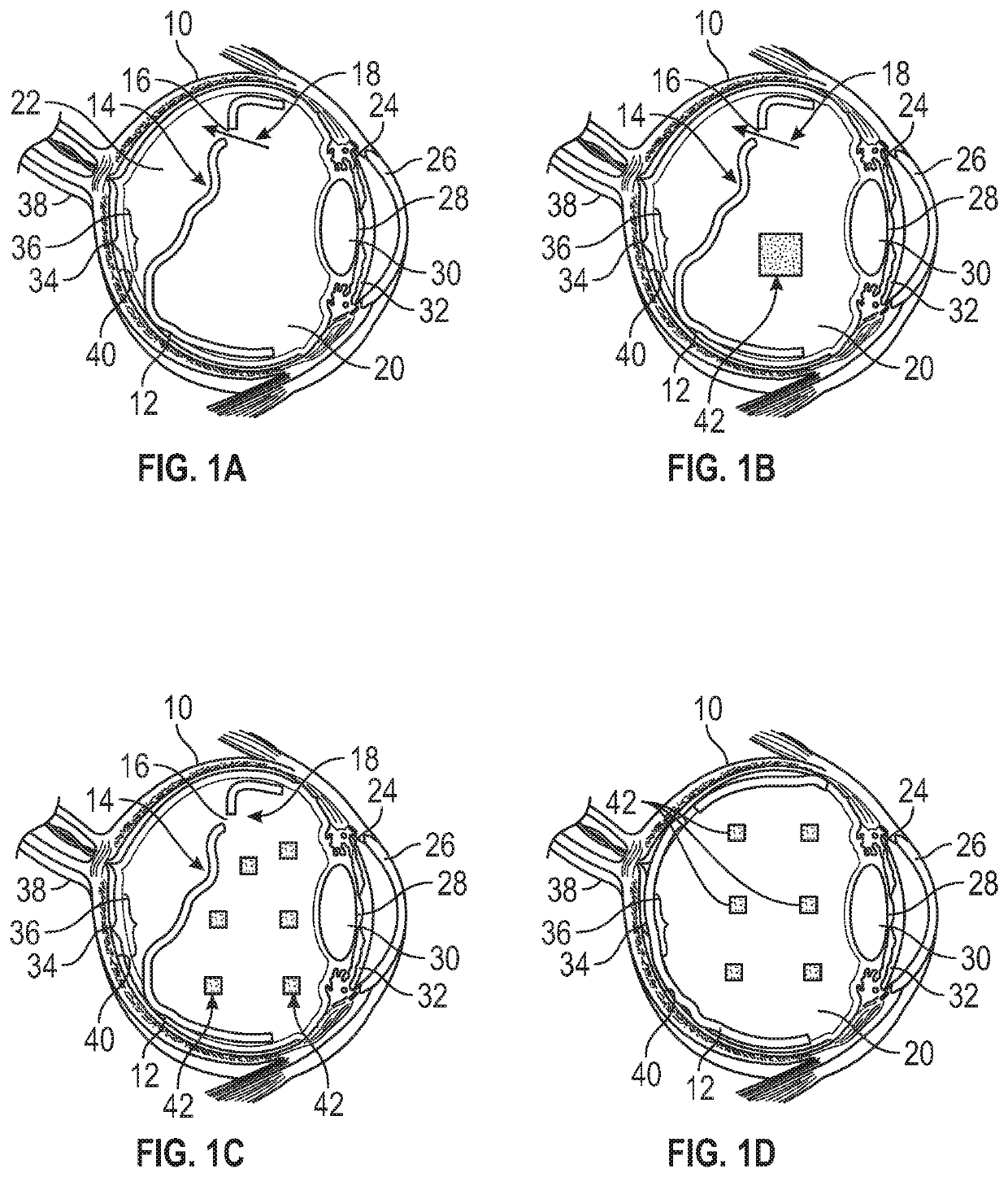 Methods and devices for treating a retinal detachment