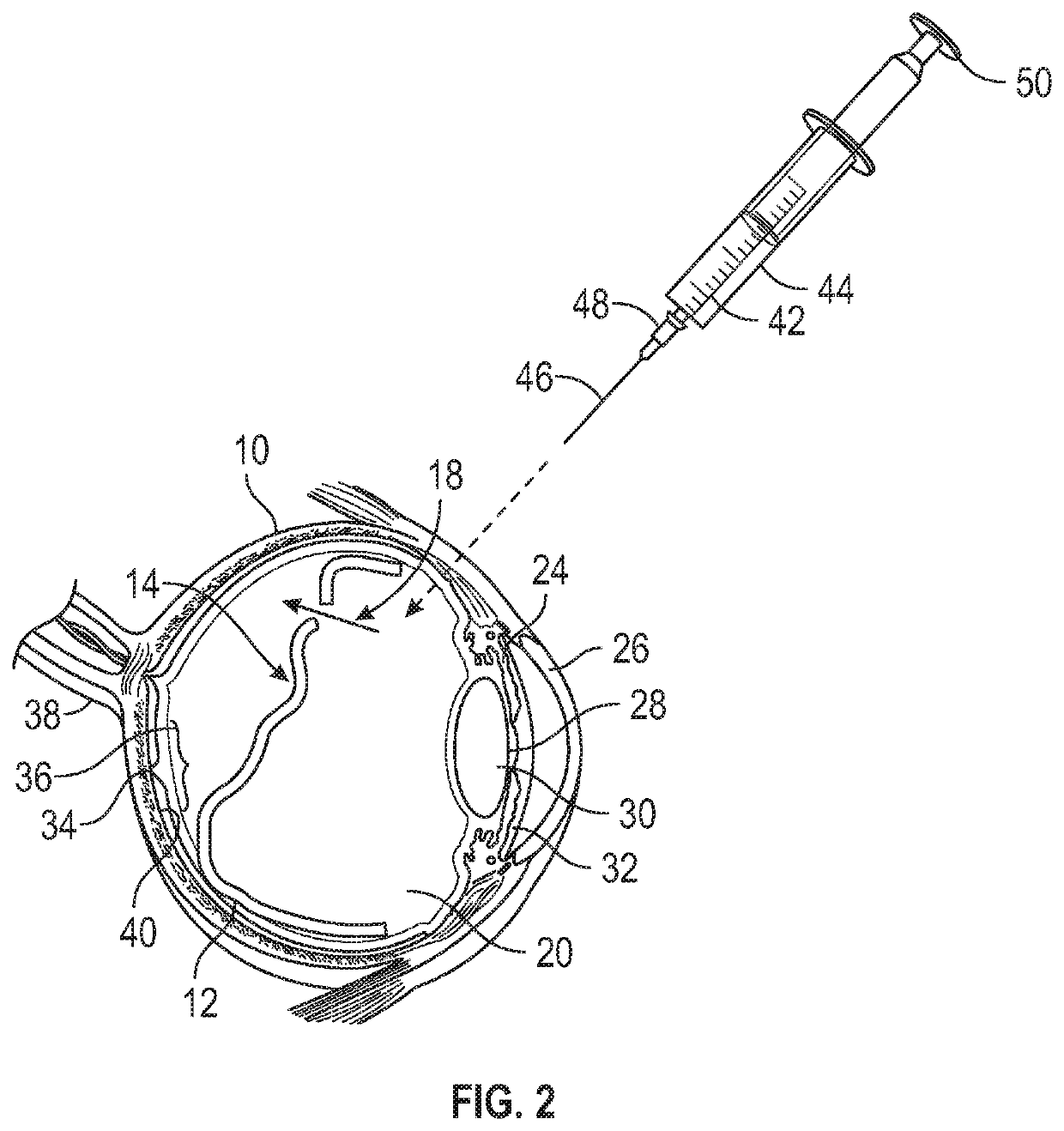 Methods and devices for treating a retinal detachment