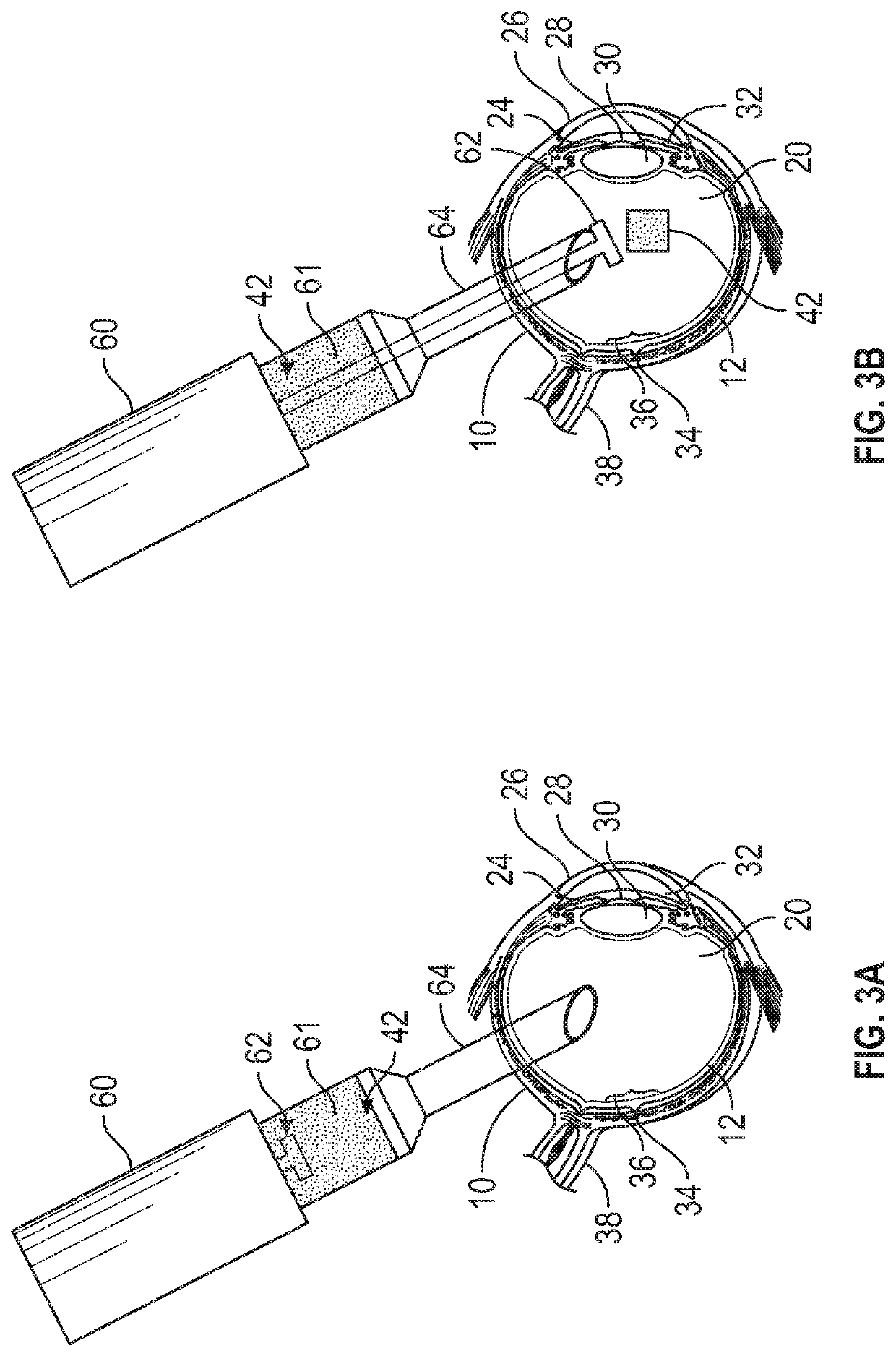 Methods and devices for treating a retinal detachment