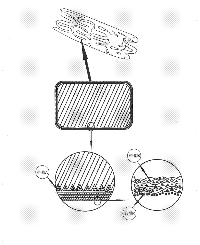 Biodegradable bracket with multiple drugs