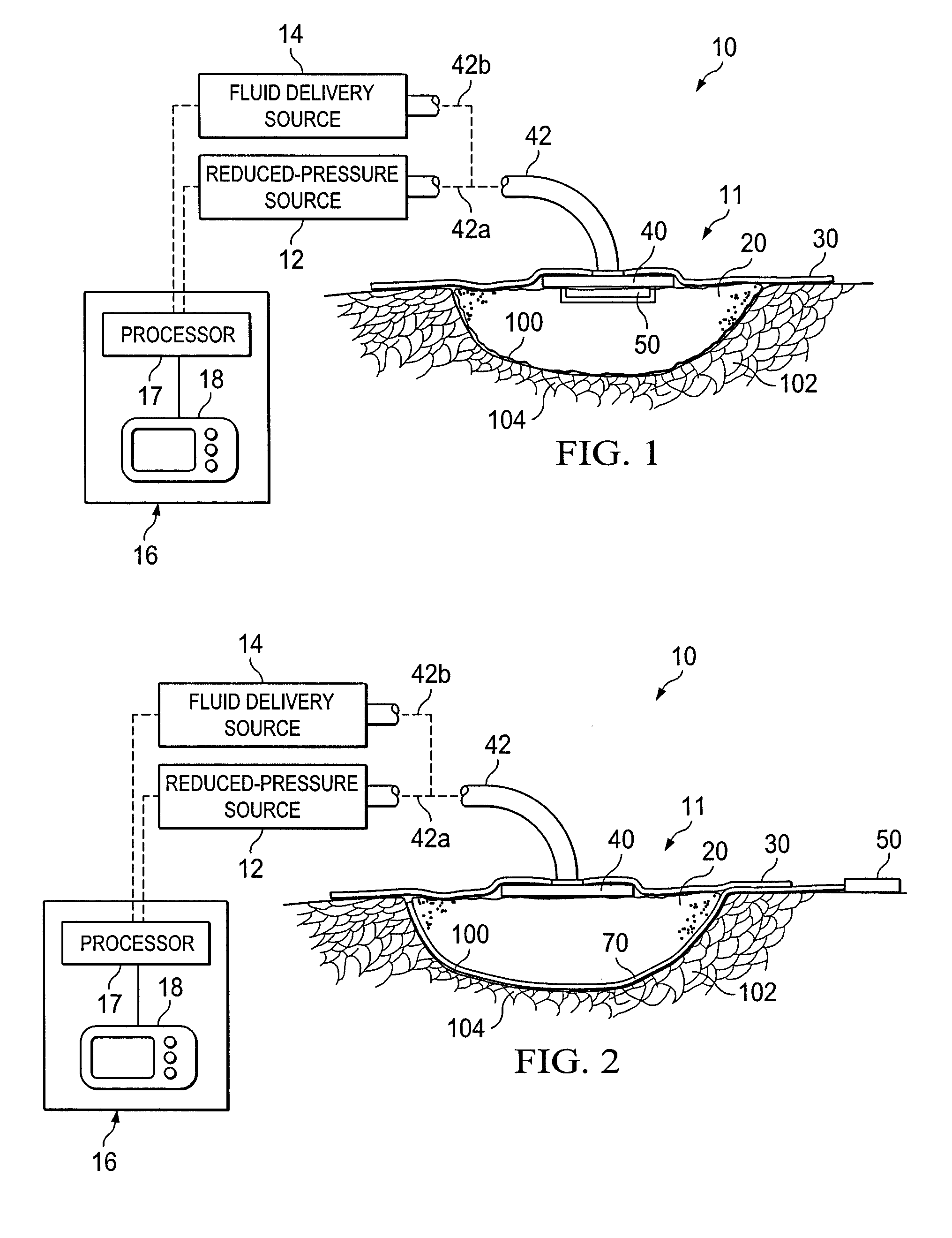 System and method for treating a wound using ultrasonic debridement