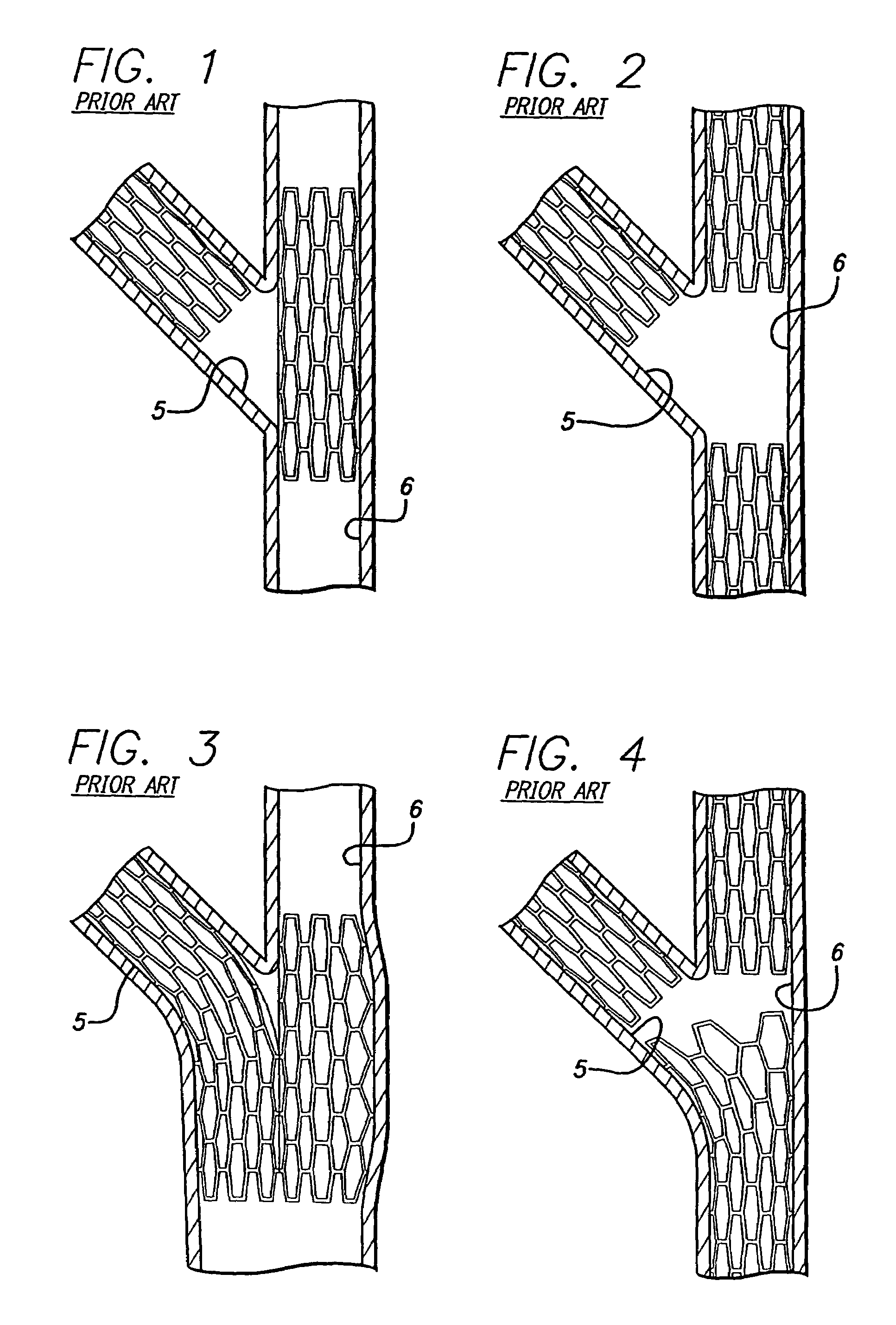 Portal design for stent for treating bifurcated vessels