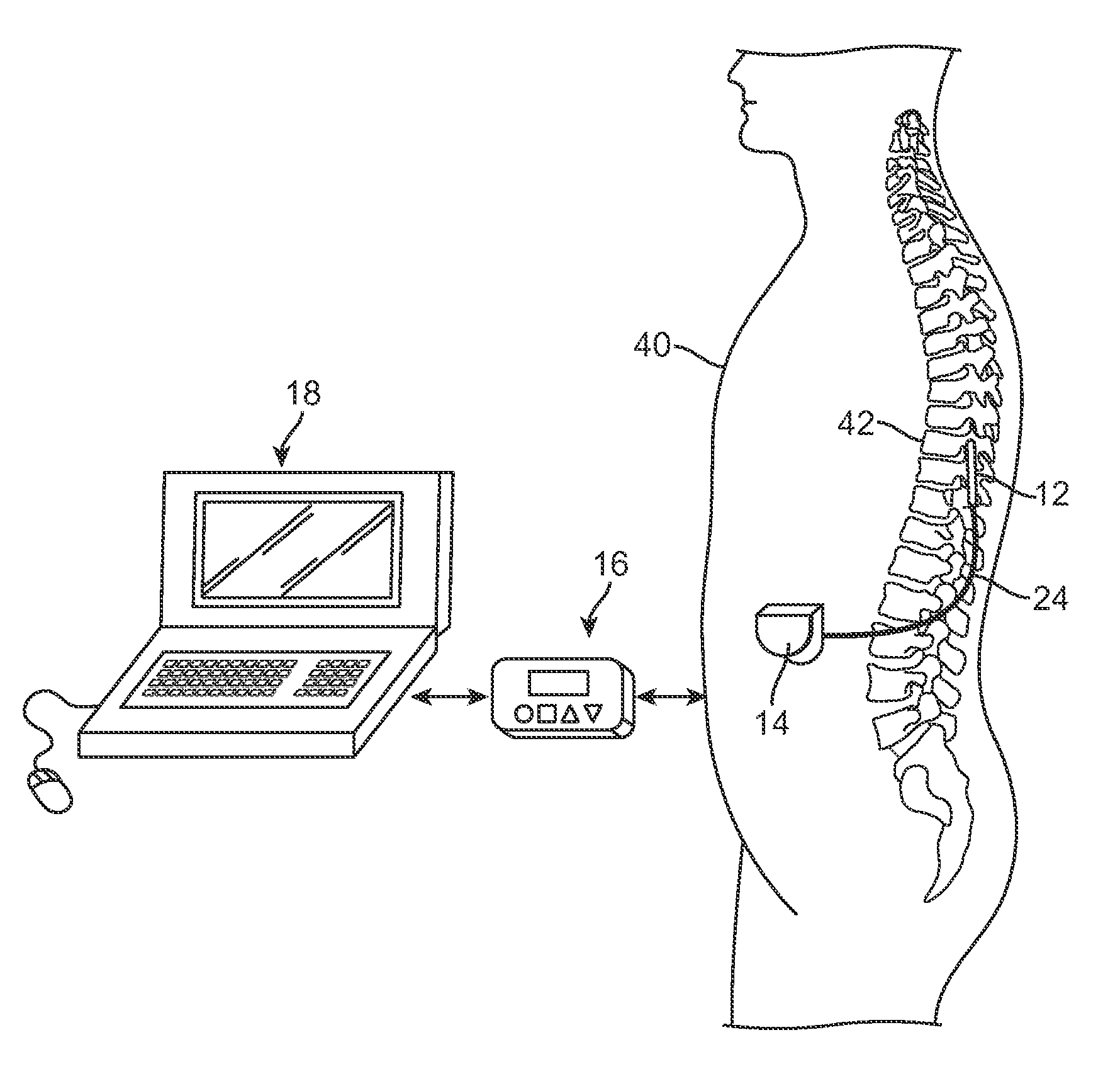 System and method for delivering modulated sub-threshold therapy to a patient