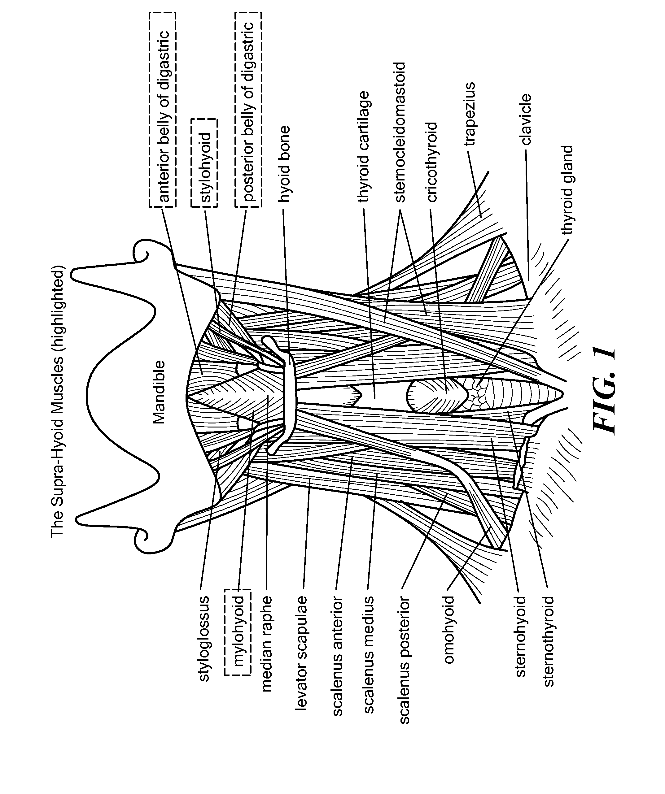 Method for Modifying Larynx Position by Trans-Positioning Muscle and Electrode Stimulation