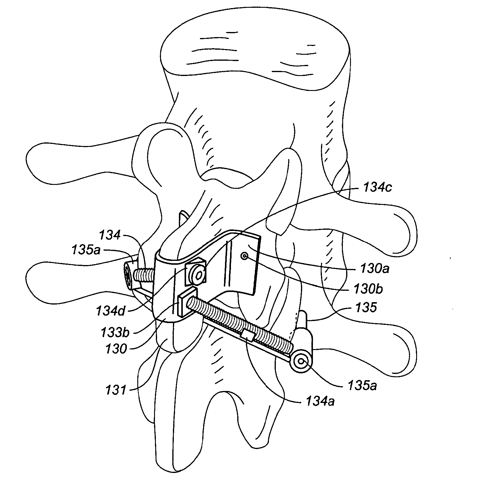 Adjustable spinal implant device and method