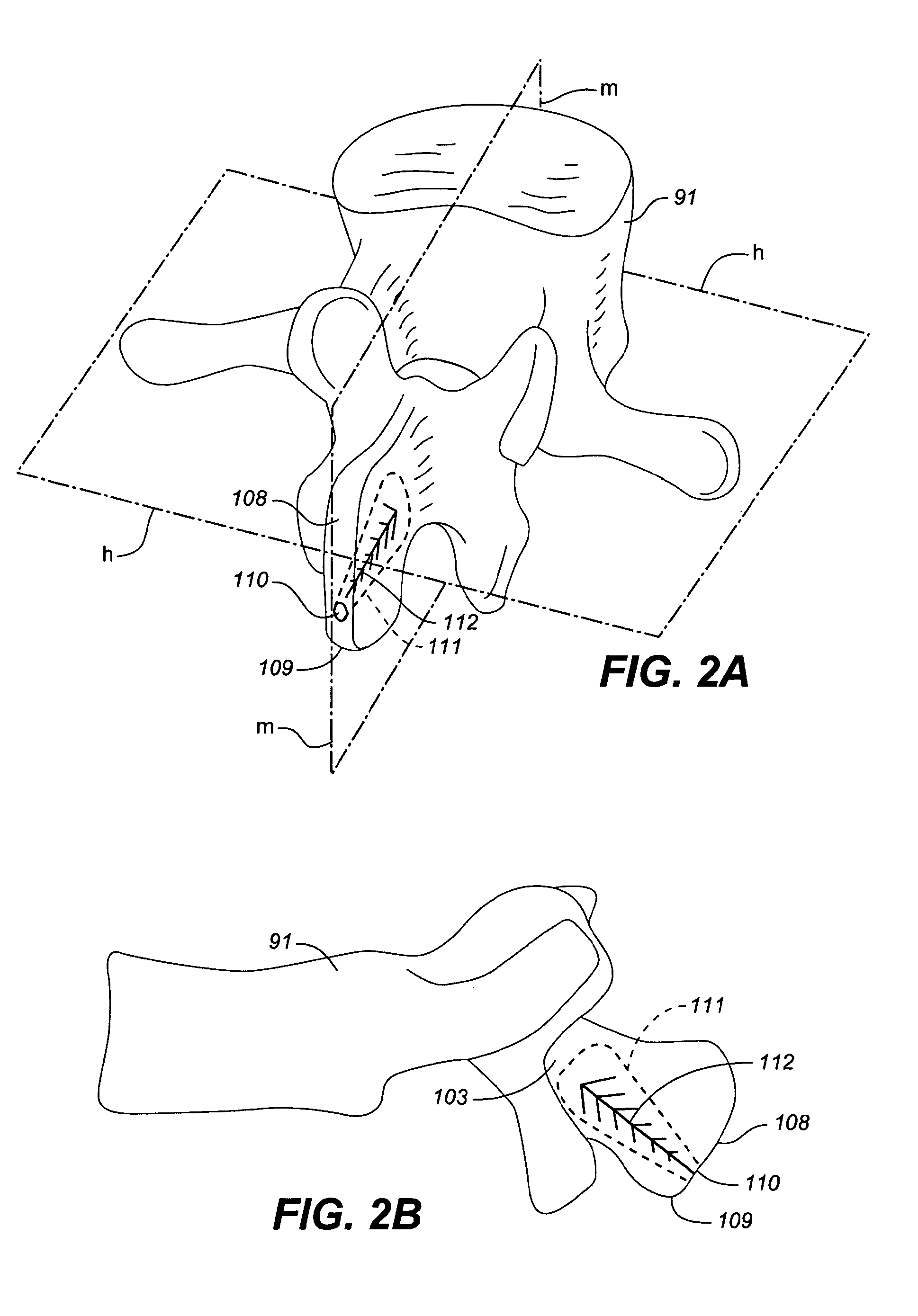Adjustable spinal implant device and method
