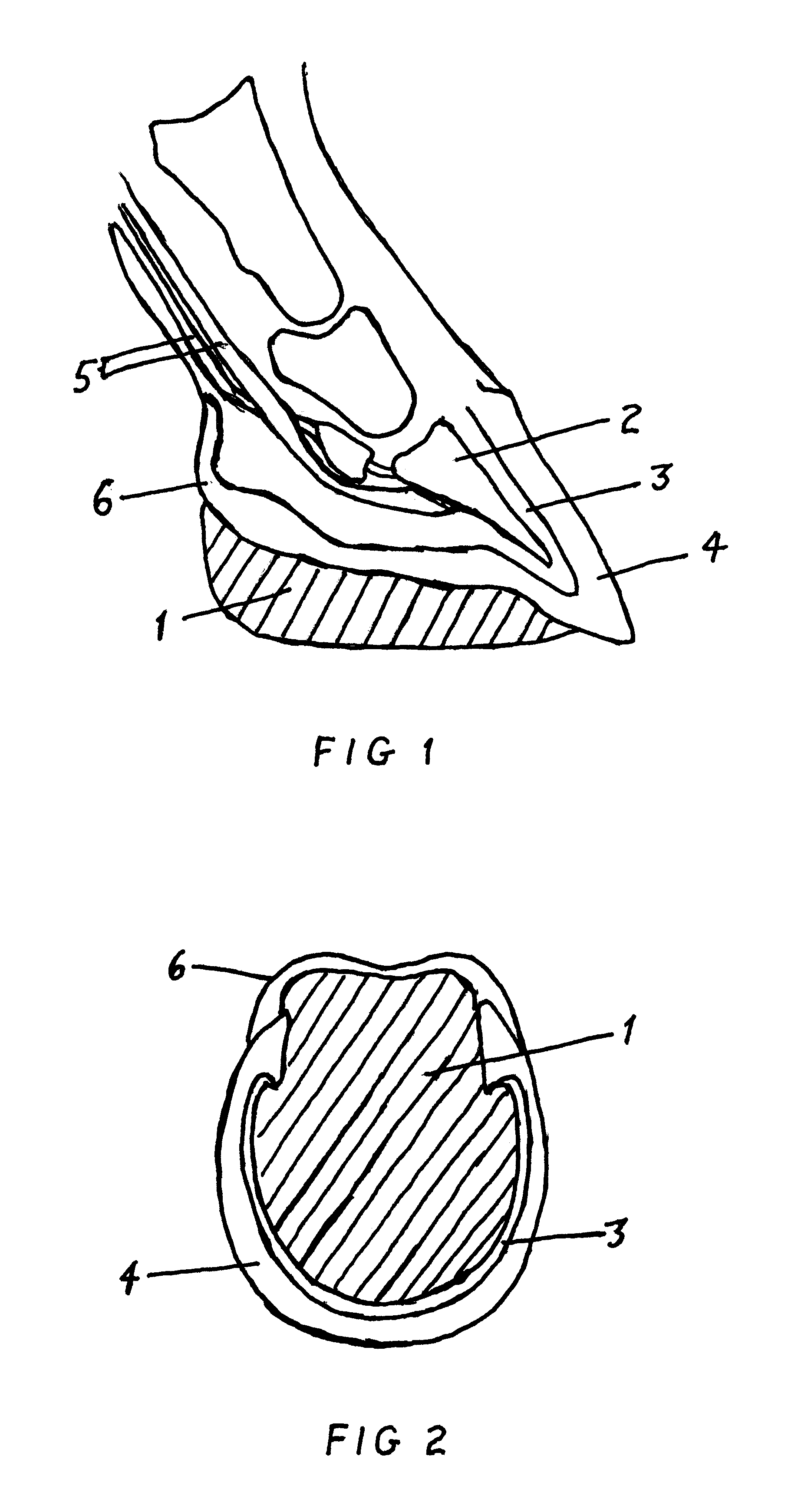 Method of treatment for founder and laminitis in the equine hoof