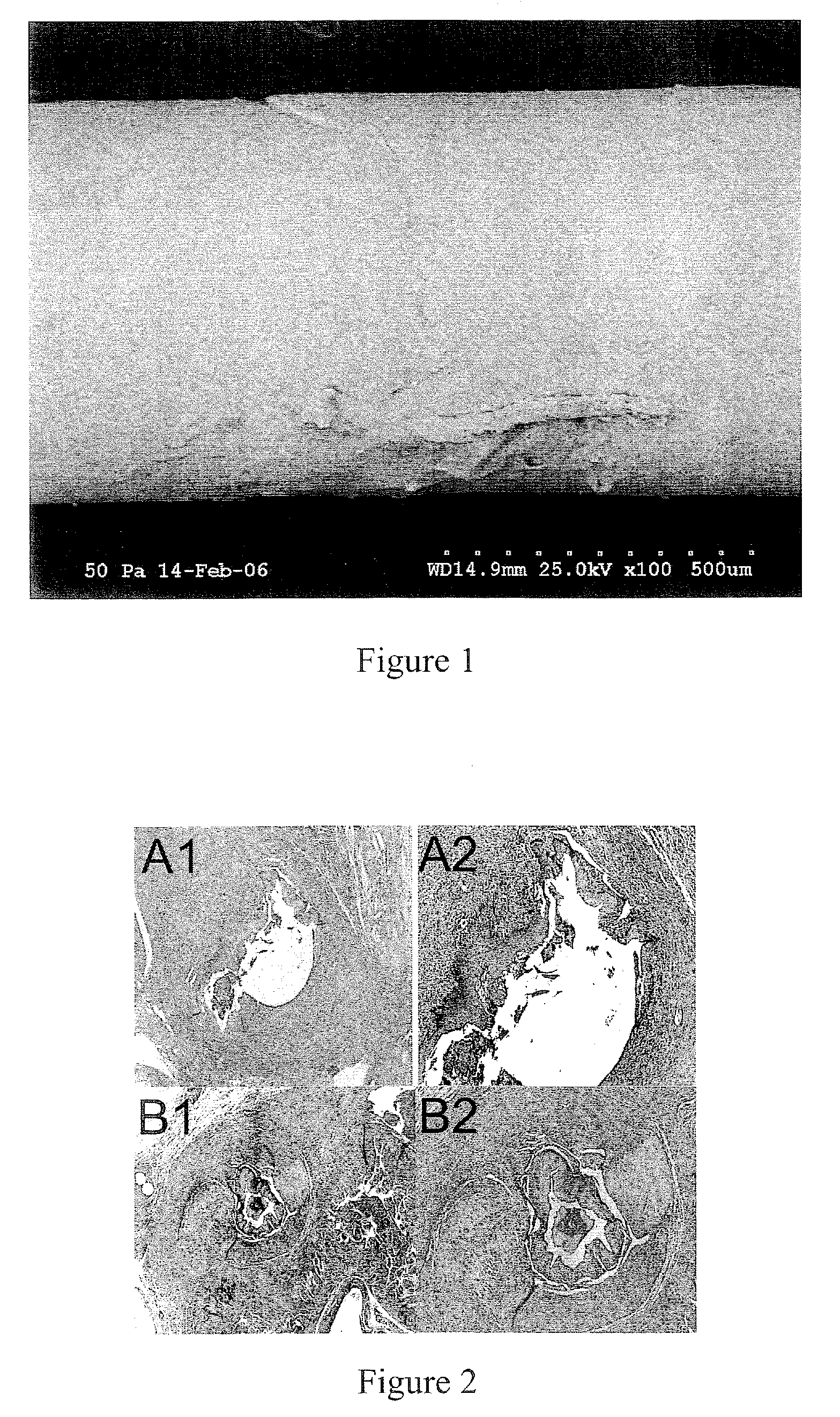 Urologic devices incorporating collagen inhibitors