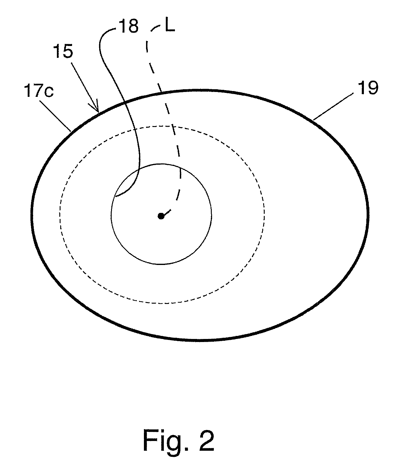 Bariatric device and method