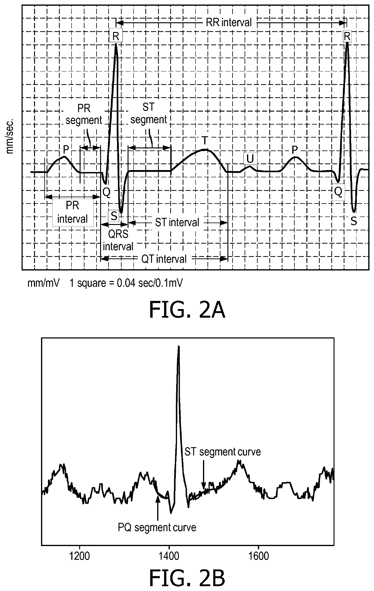 A device, system, and method for detecting and determining cardiac and non-cardiac pain