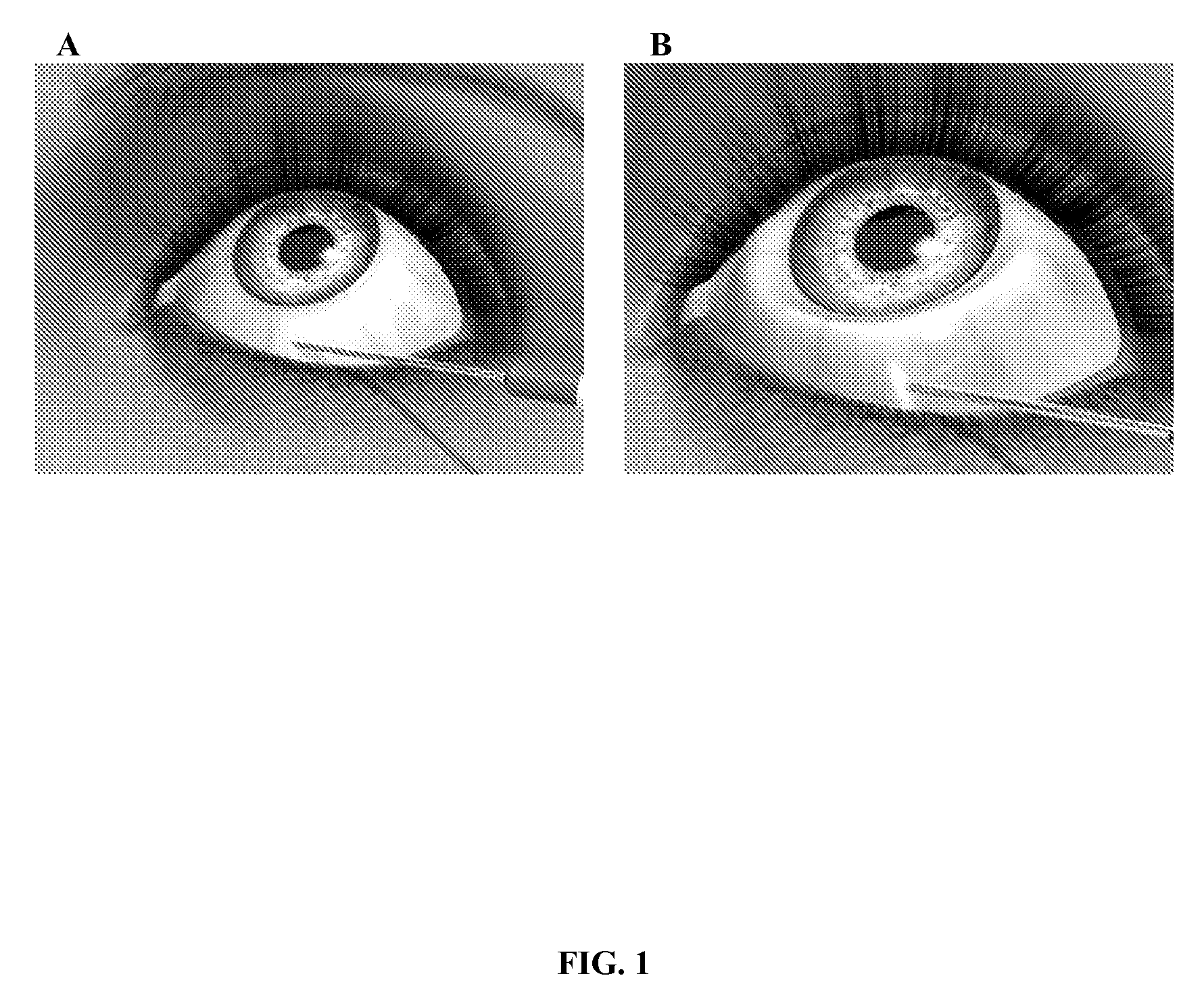 Method for Treating Primary and Secondary Forms of Glaucoma
