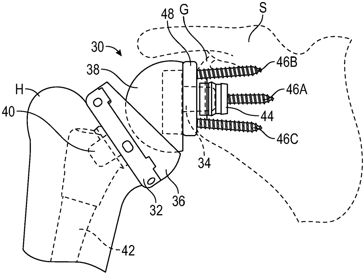 Patient-specific augmented glenoid systems