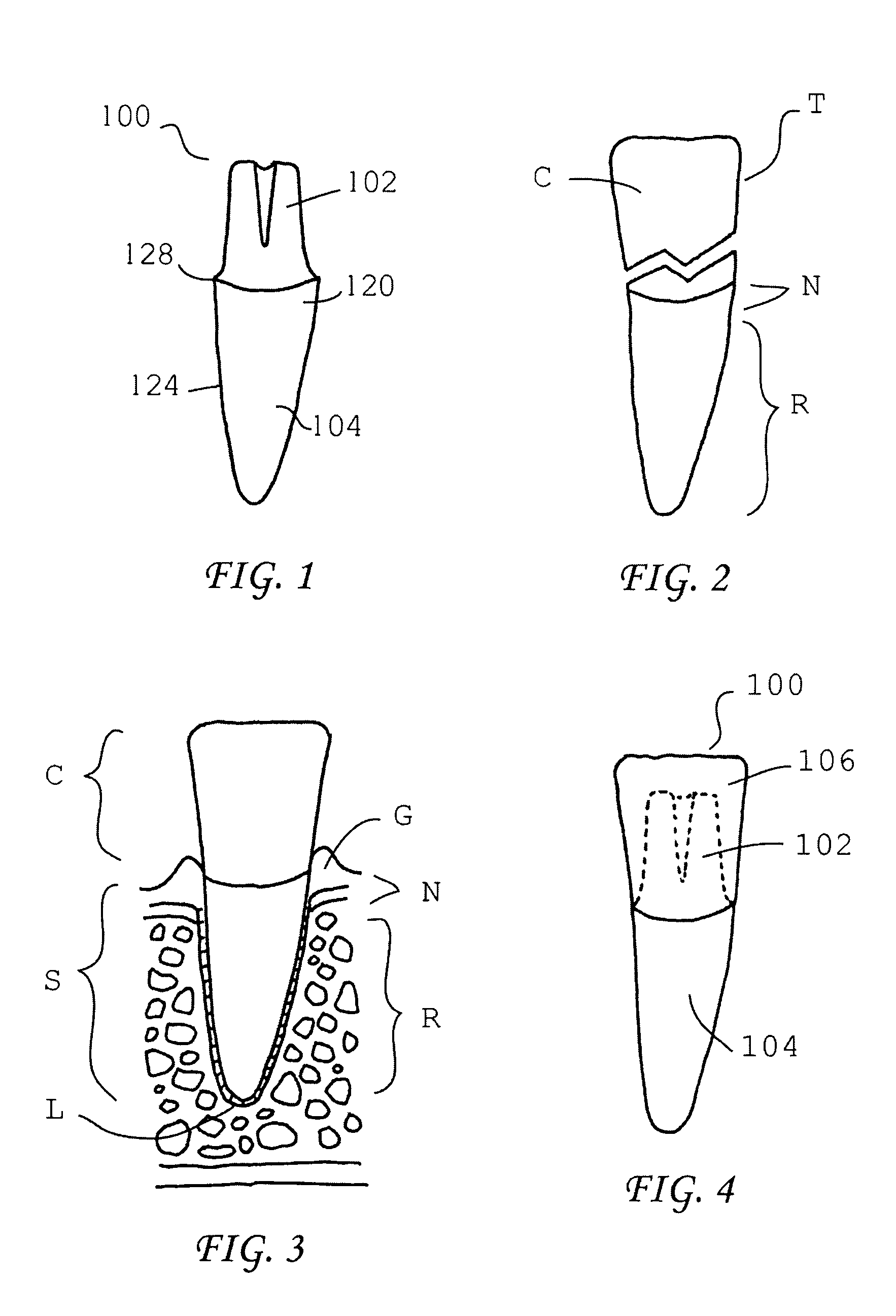Dental implants and methods for their fabrication and use