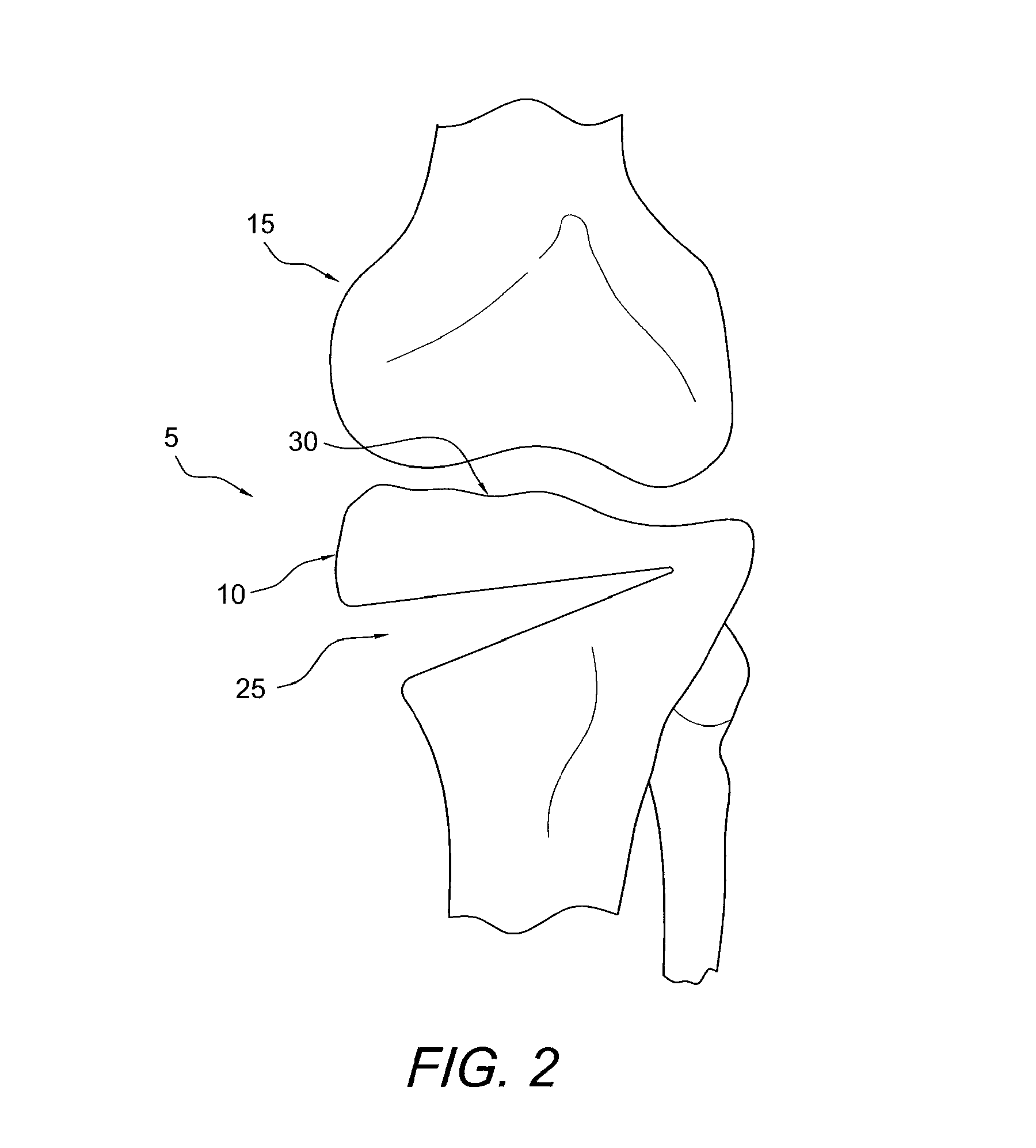 Method for performing an open wedge, high tibial osteotomy