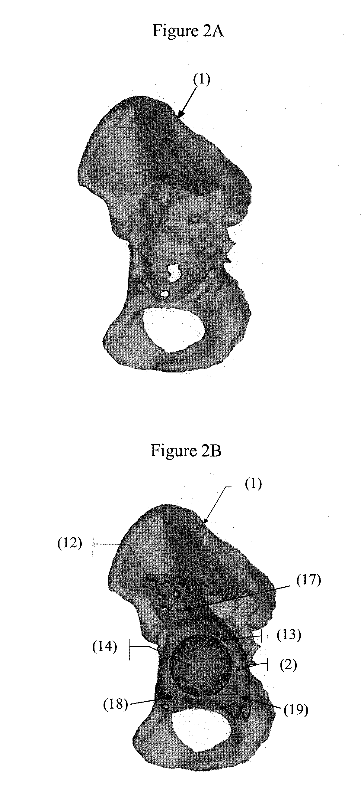 Customized surgical guides, methods for manufacturing and uses thereof