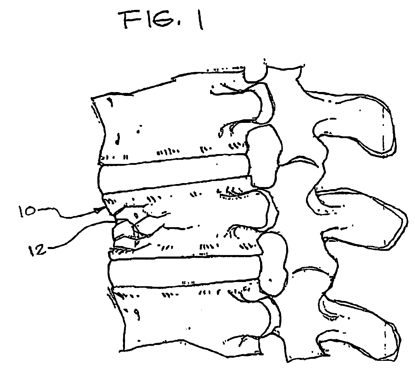 Expandable porous mesh bag device and methods of use for reduction, filling, fixation and supporting of bone