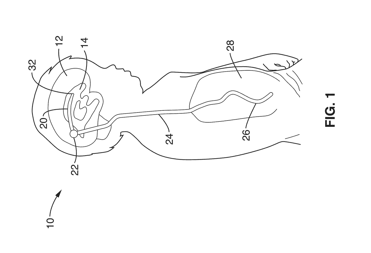 Unobstructing microdevices for self-clearing implantable catheters