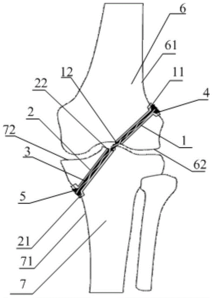 Ligament Reconstruction System