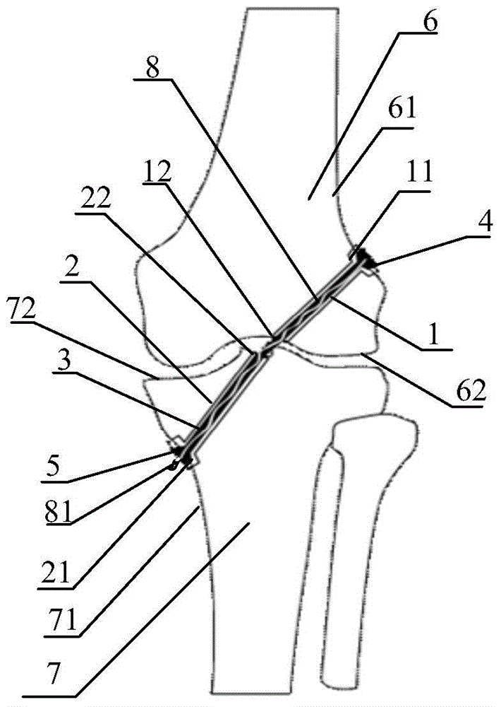 Ligament Reconstruction System