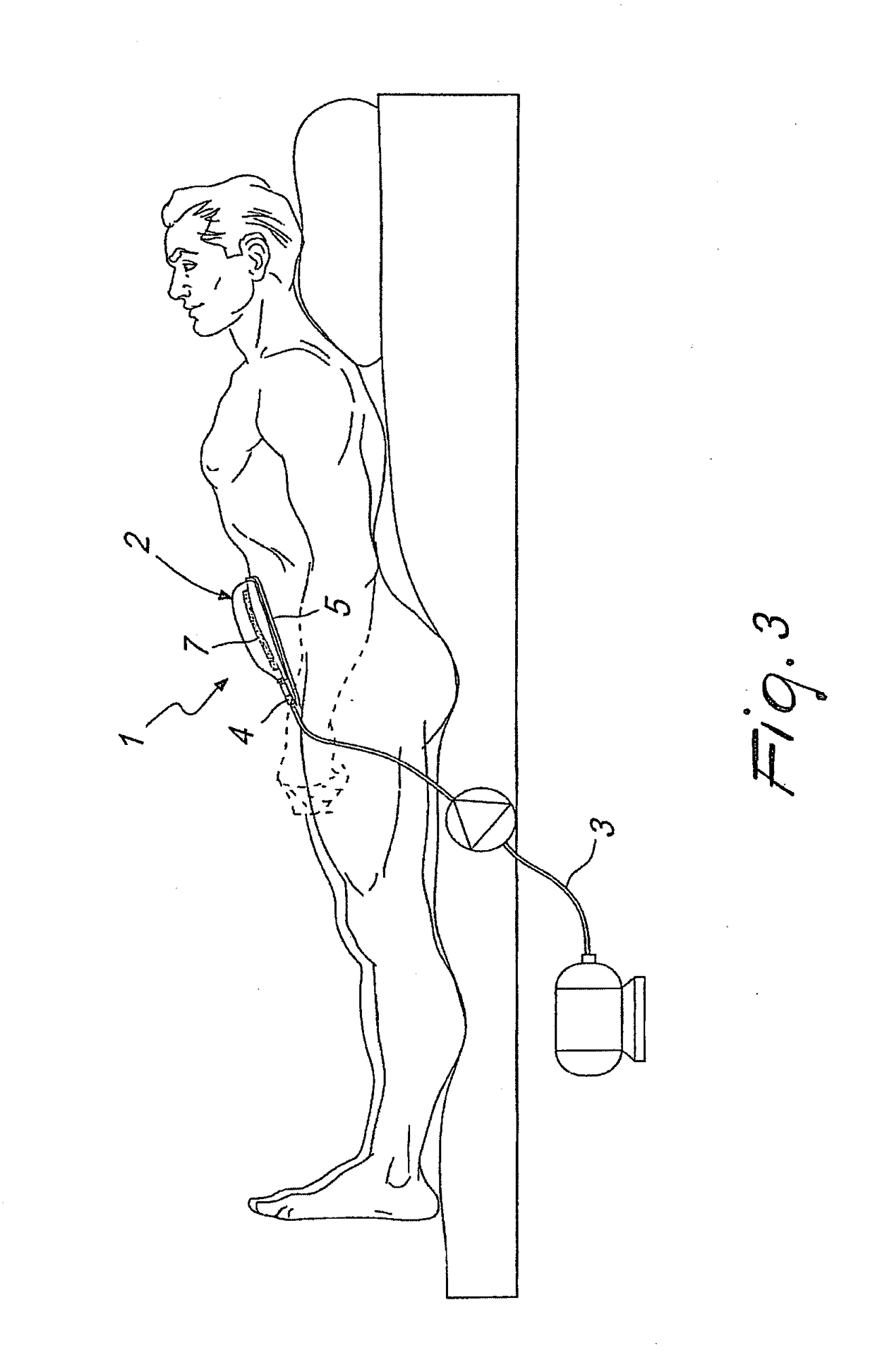 Drainage device particularly for aspiration in case of therapies with aspiration, fistulas, dehiscences of surgical wounds, bedsores, traumas and similar lesions