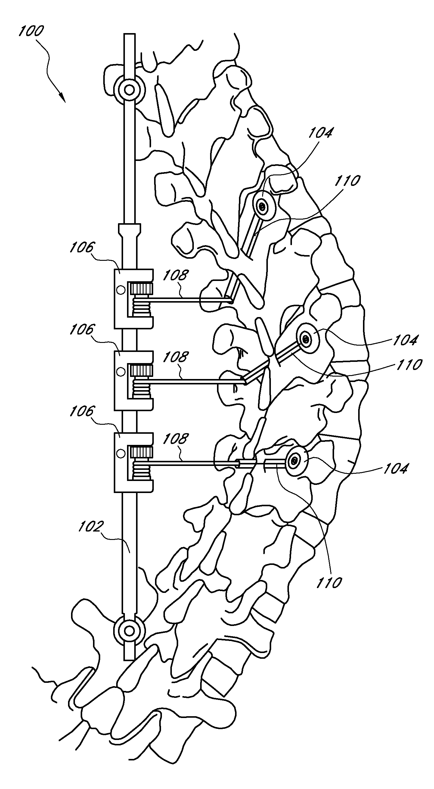 Medical device and method to correct deformity