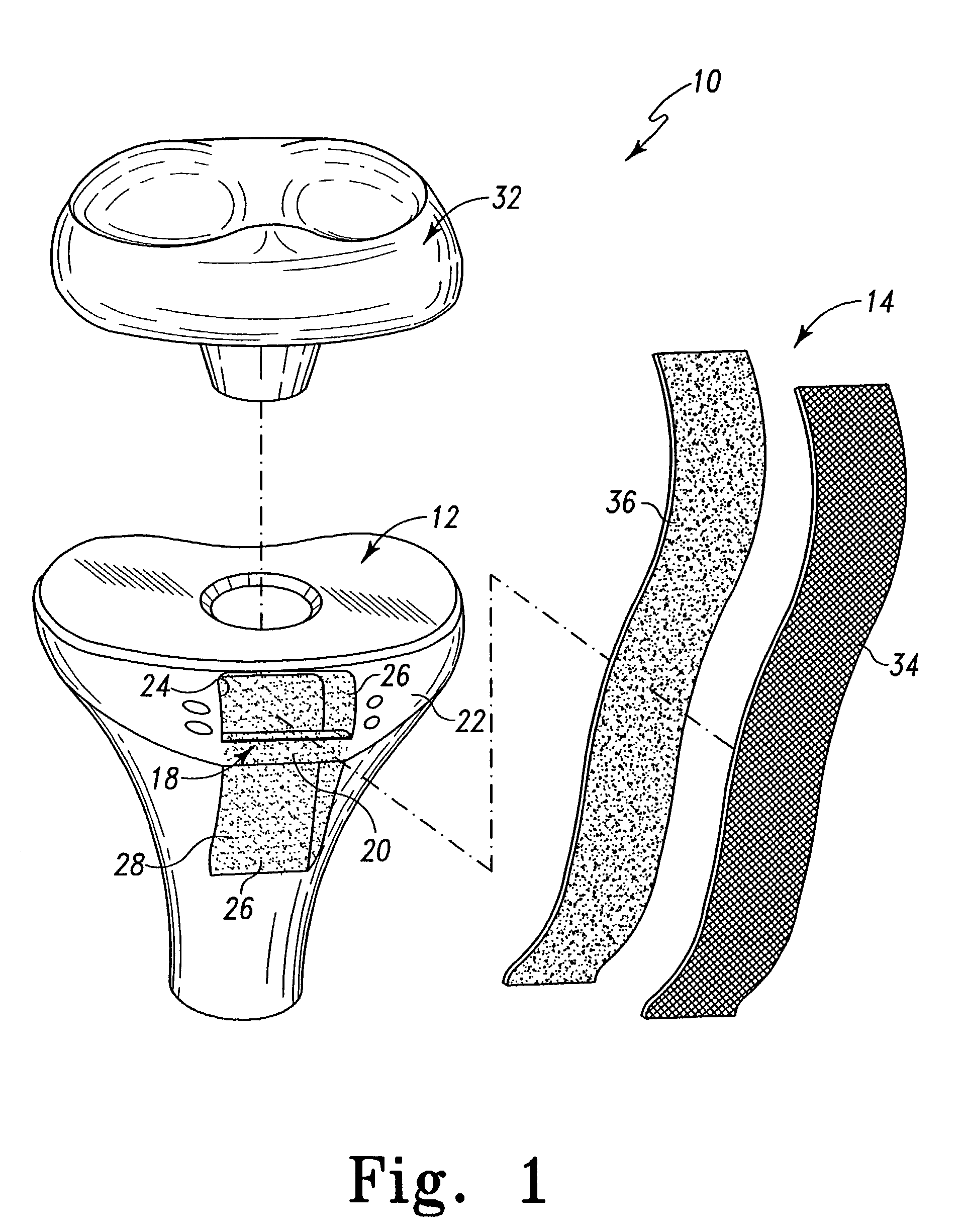 Method for securing soft tissue to an artificial prosthesis
