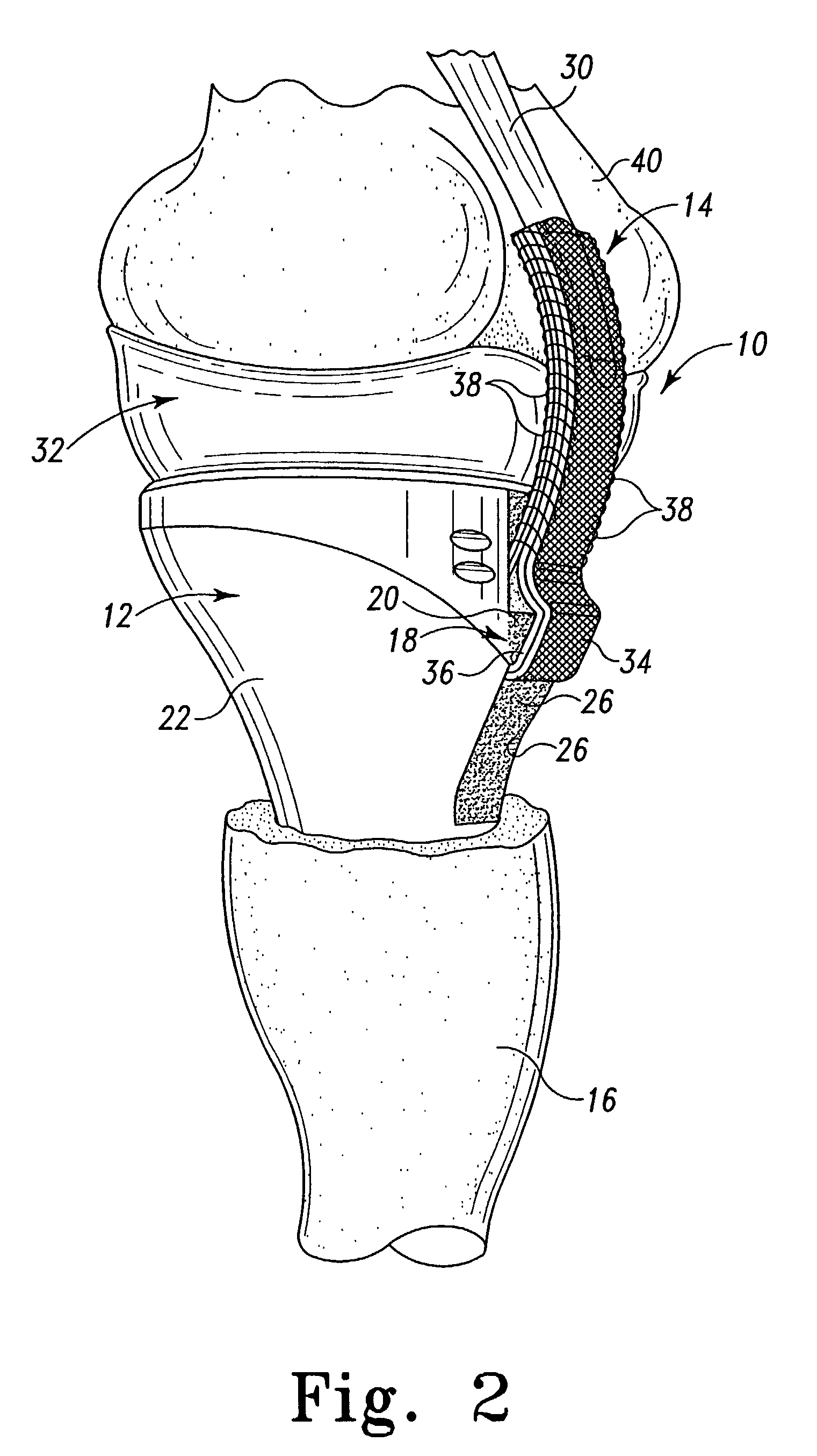 Method for securing soft tissue to an artificial prosthesis