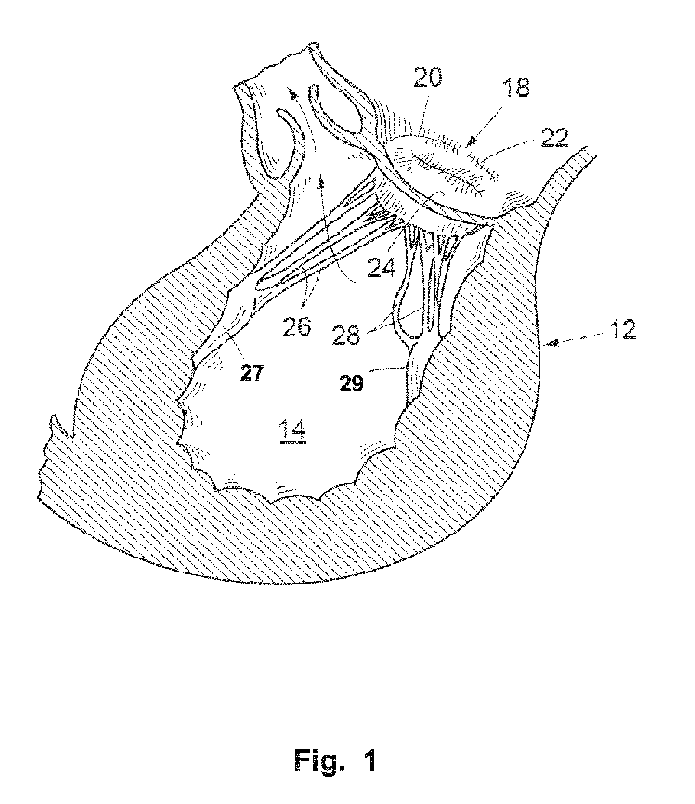 Device And A Method For Improving The Function Of A Heart Valve
