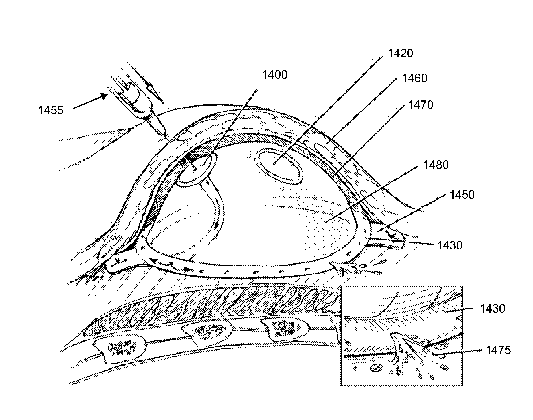Systems and methods for tissue expansion with fluid delivery and drainage system