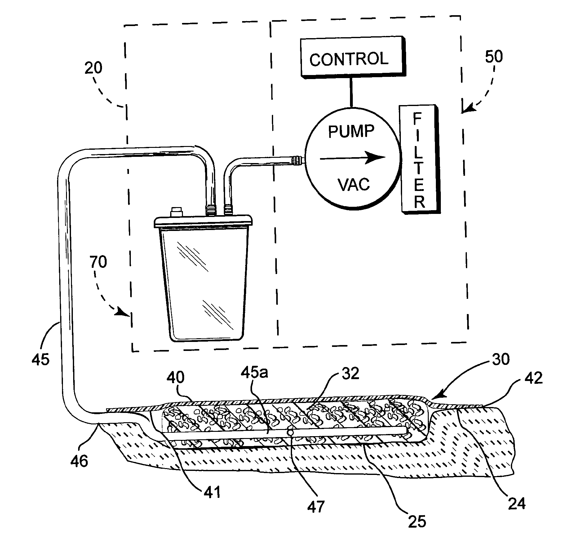 Reduced pressure treatment system