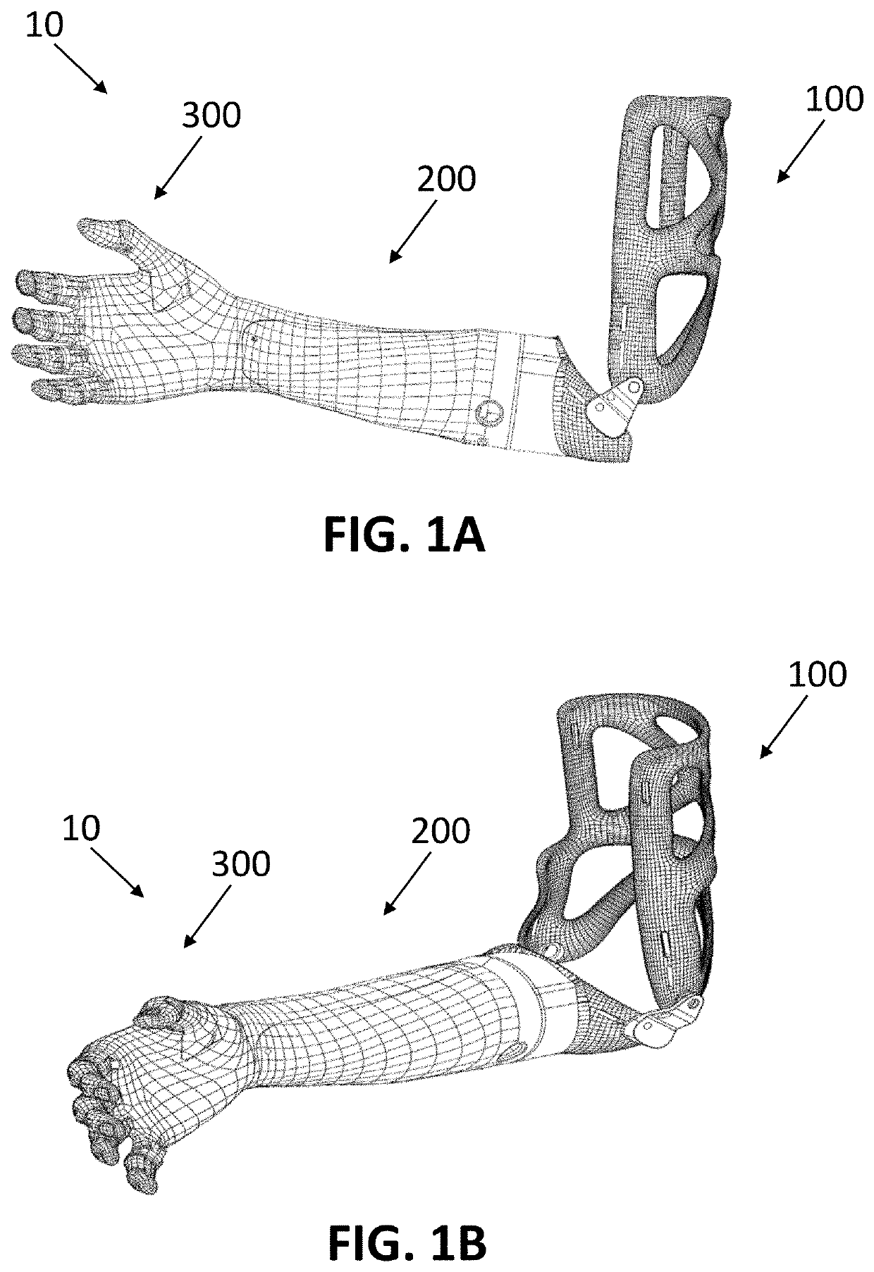 Socket for Upper Extremity Prosthesis