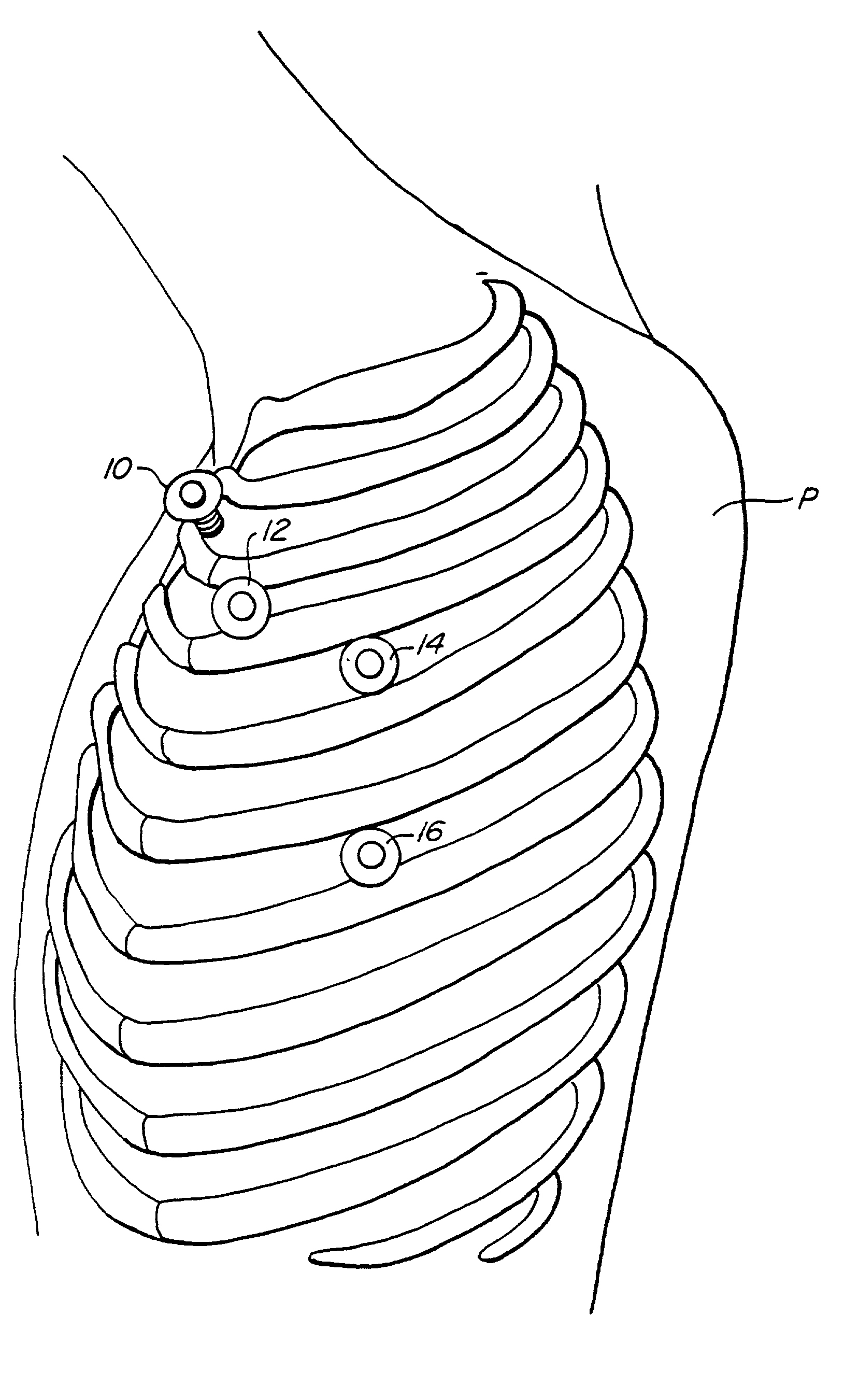 Methods and systems for performing thoracoscopic cardiac bypass and other procedures