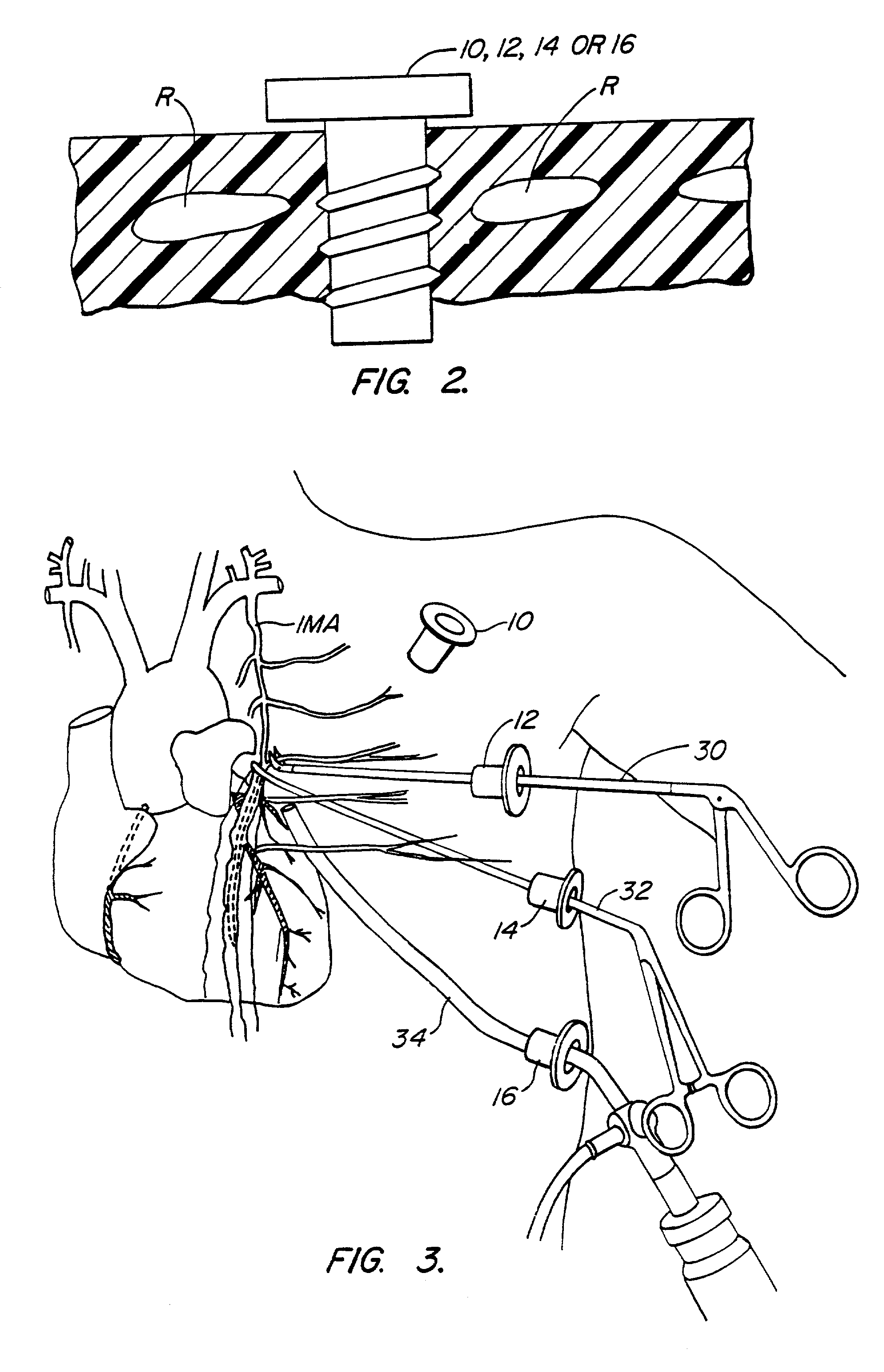 Methods and systems for performing thoracoscopic cardiac bypass and other procedures