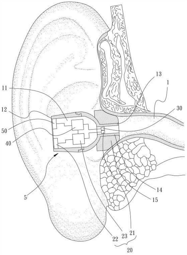 An in-ear voice device