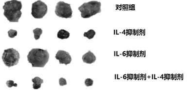 Application of IL-6R inhibitor and IL-4R inhibitor combined drug in breast cancer chemotherapy drugs