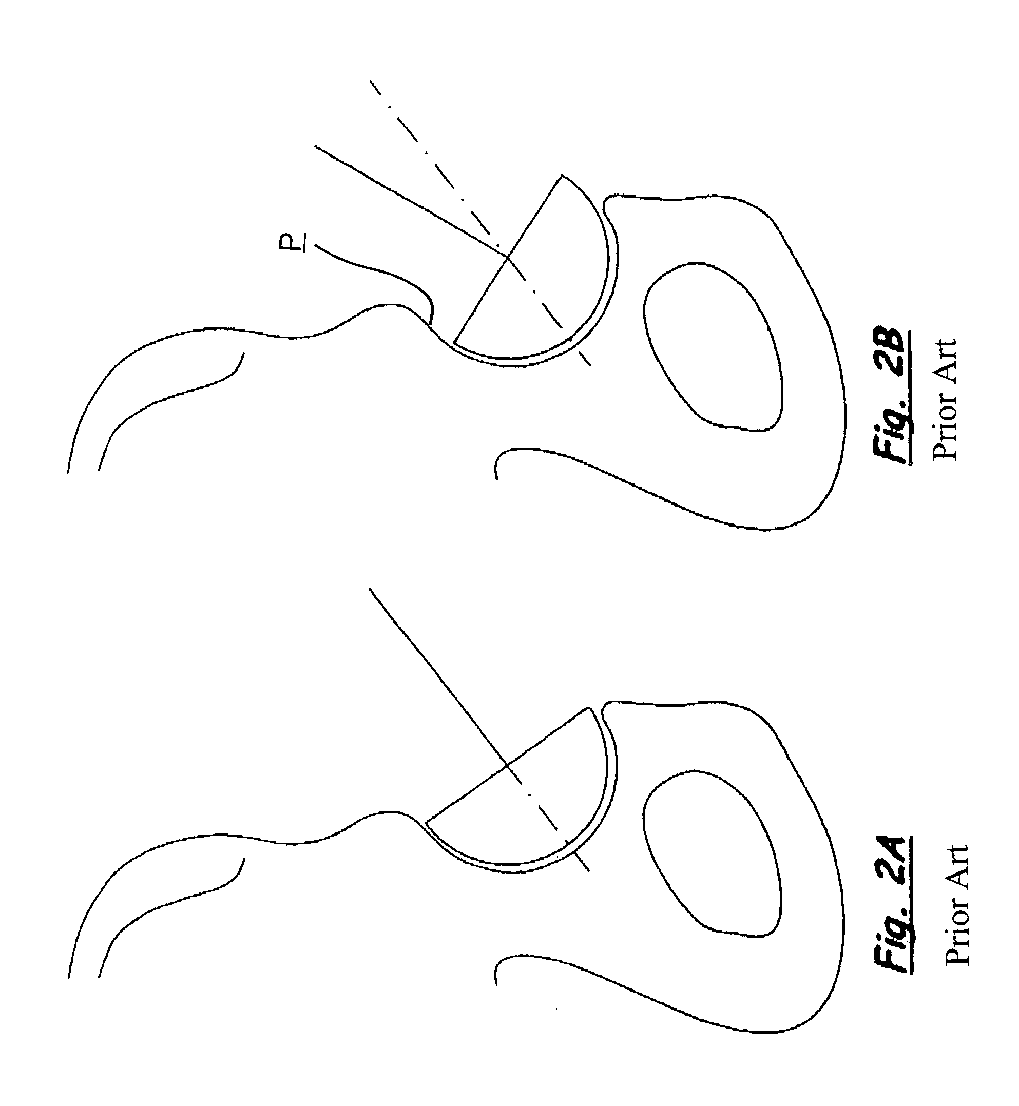 Expandable surgical reaming tool