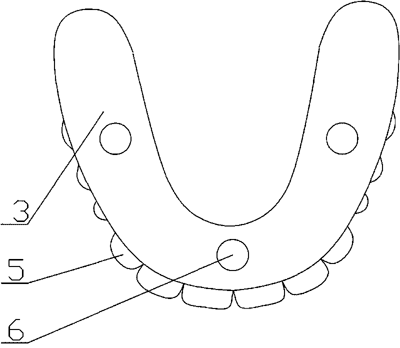 Upper jaw complete denture