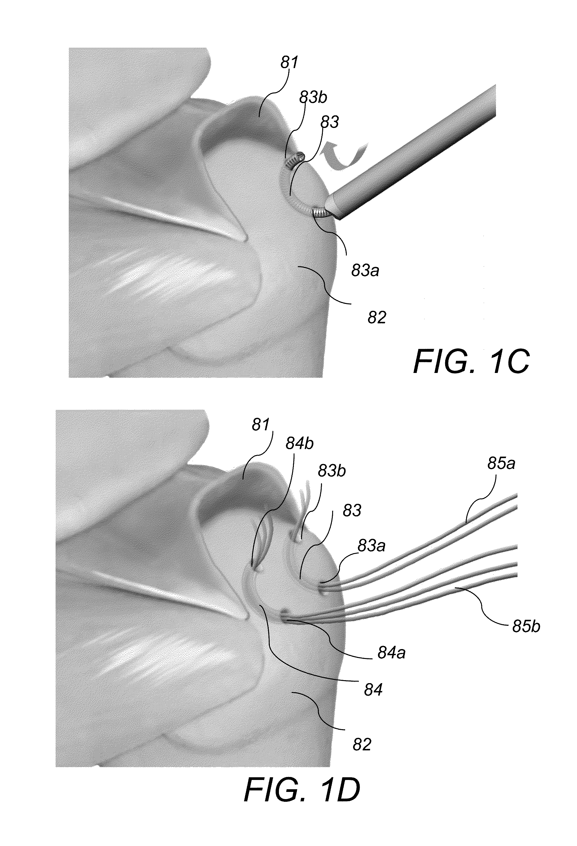 System and method for forming a curved tunnel in bone