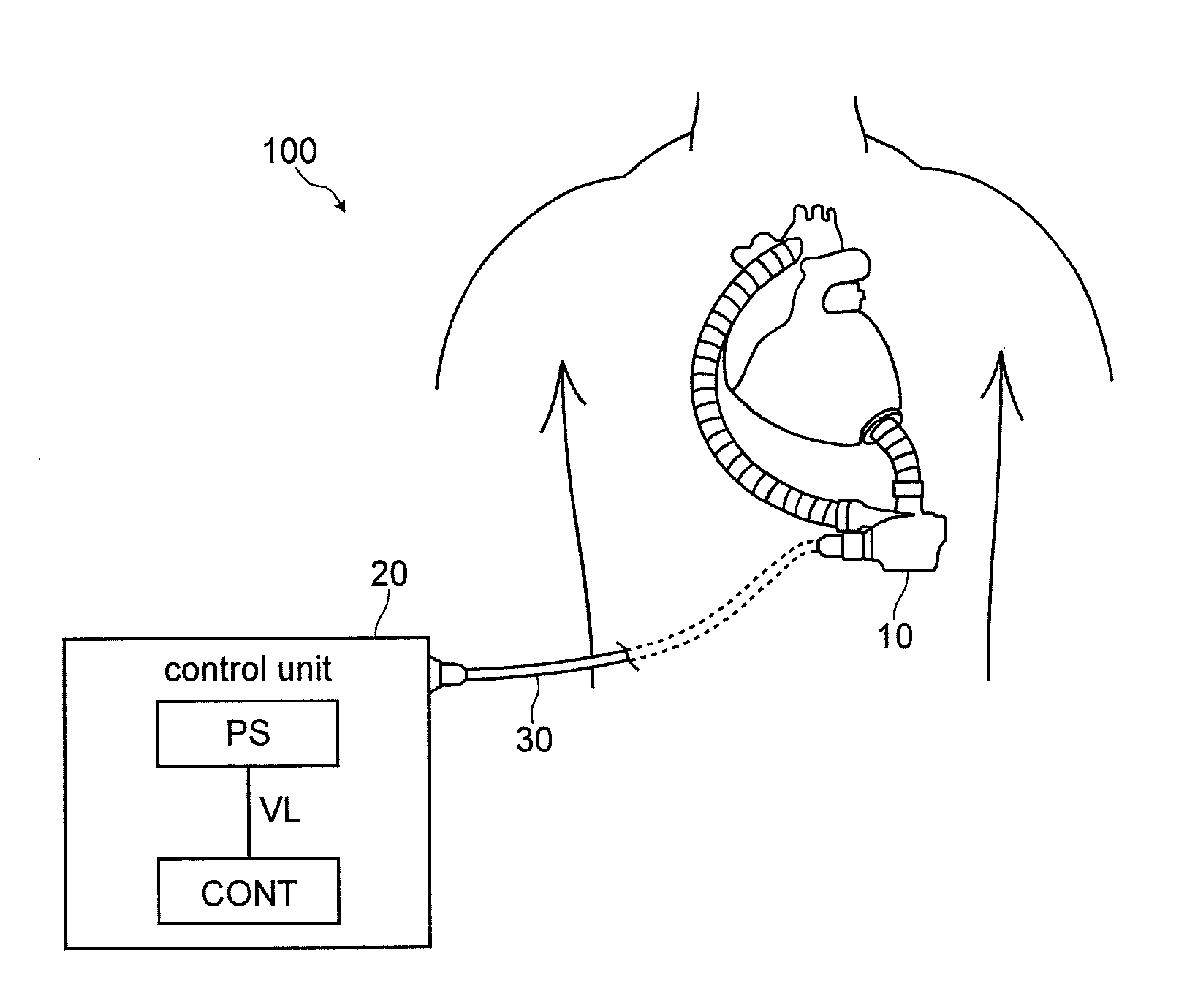 Auxiliary artificial heart pump drive device and auxiliary artifical heart system