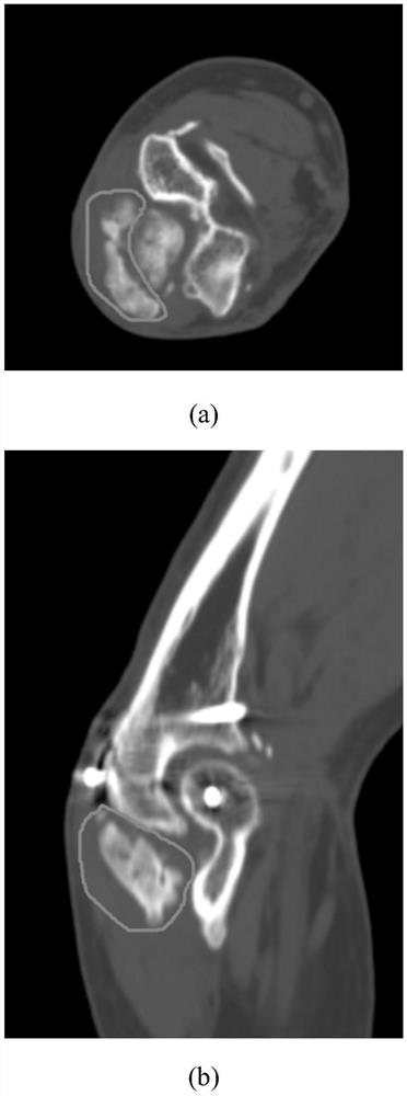 Heterotopic ossification CT image segmentation method and device, and heterotopic ossification CT image segmentation three-dimensional reconstruction method and device