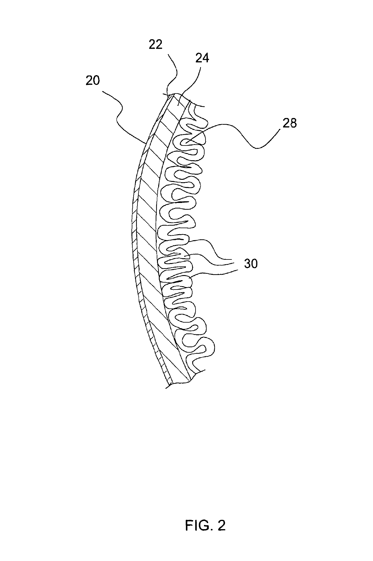 Device and method for endoluminal therapy