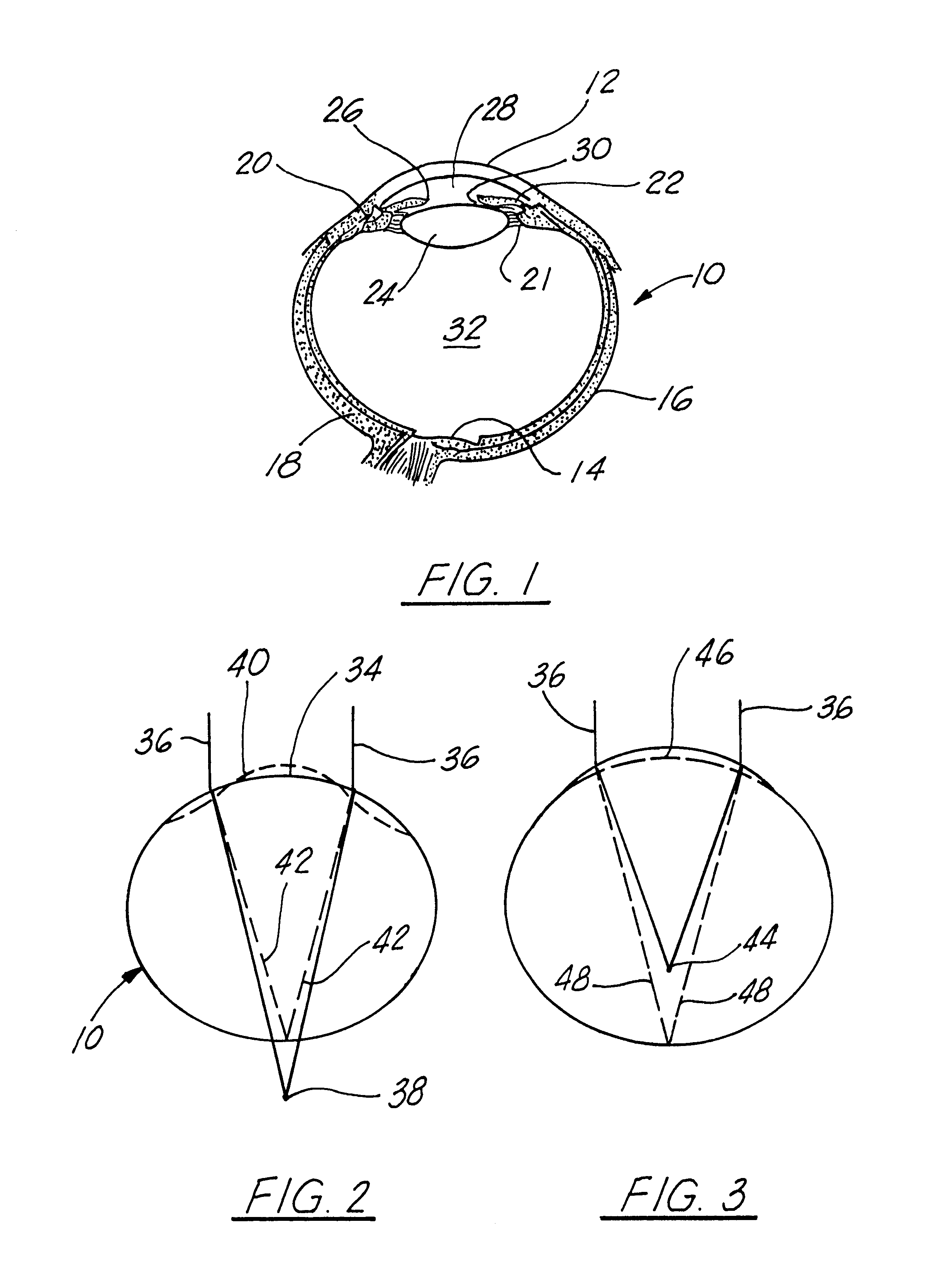 Corneal implant and method of manufacture