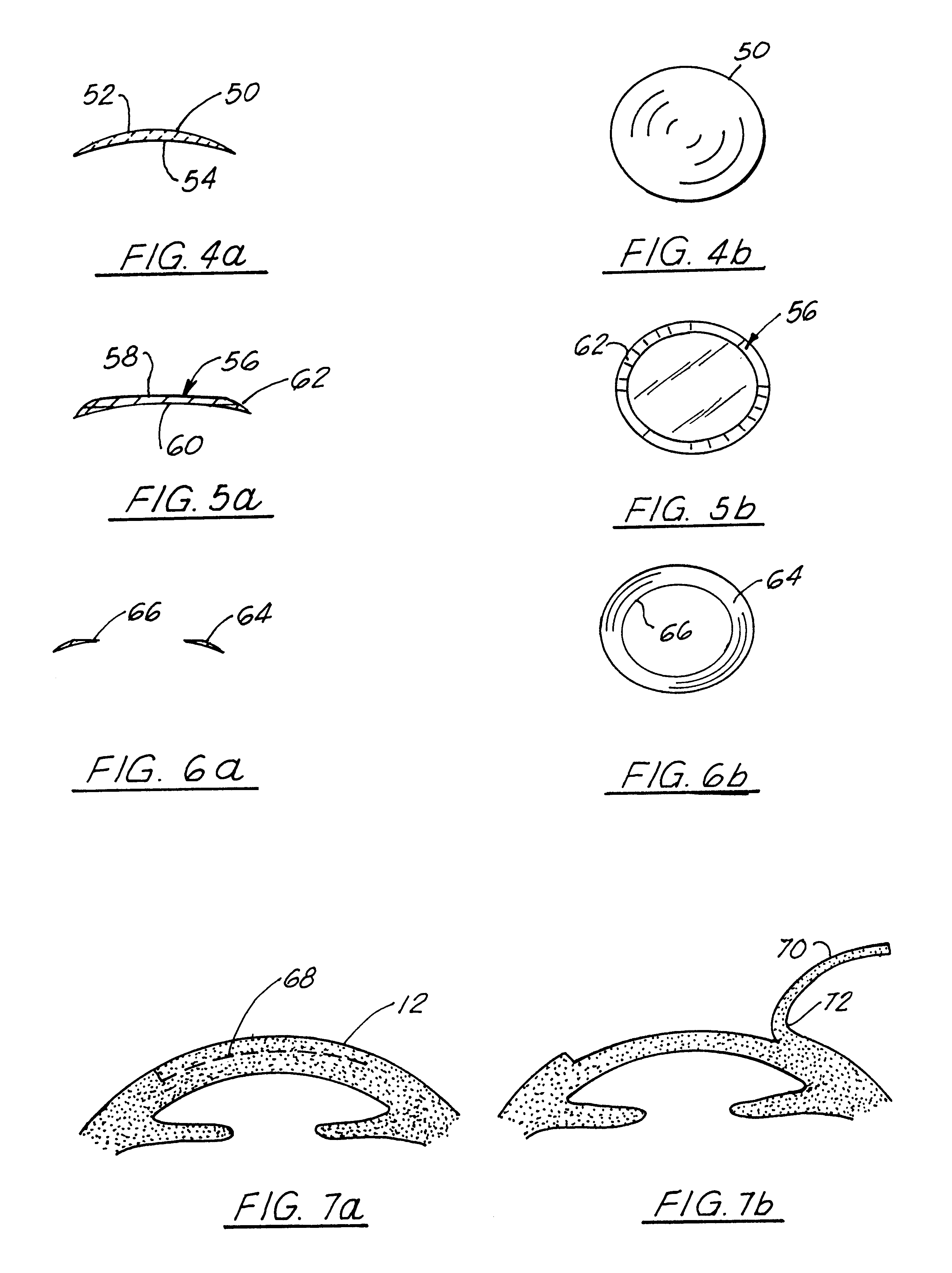 Corneal implant and method of manufacture