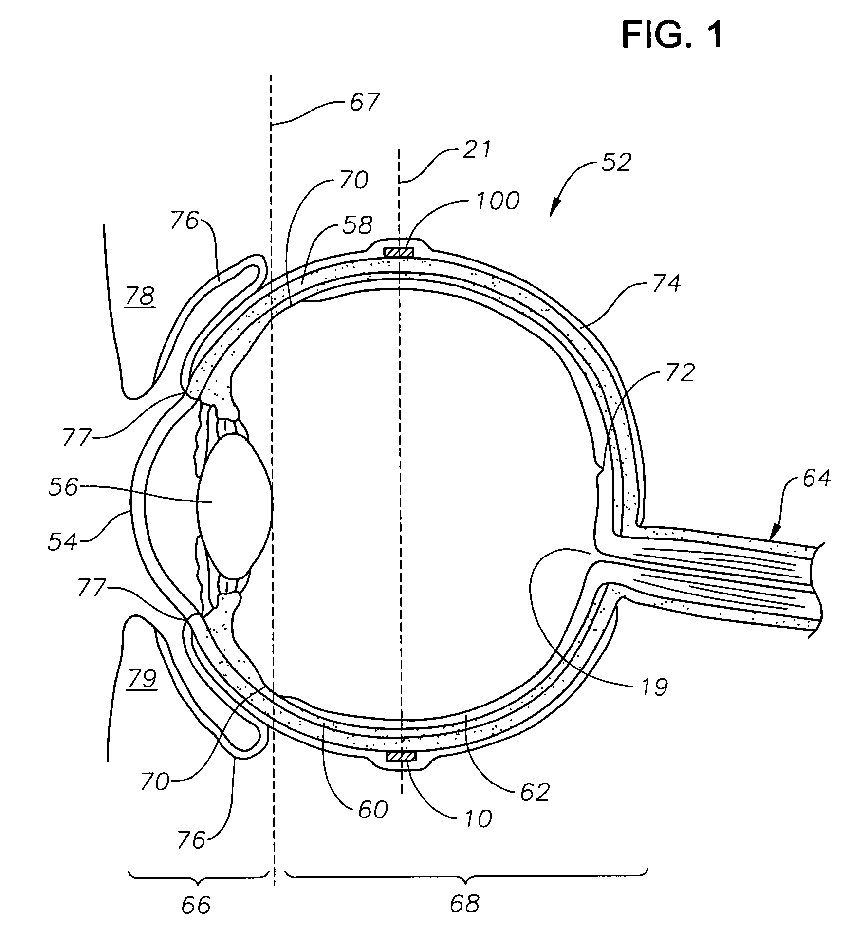 Ophthalmic drug delivery device