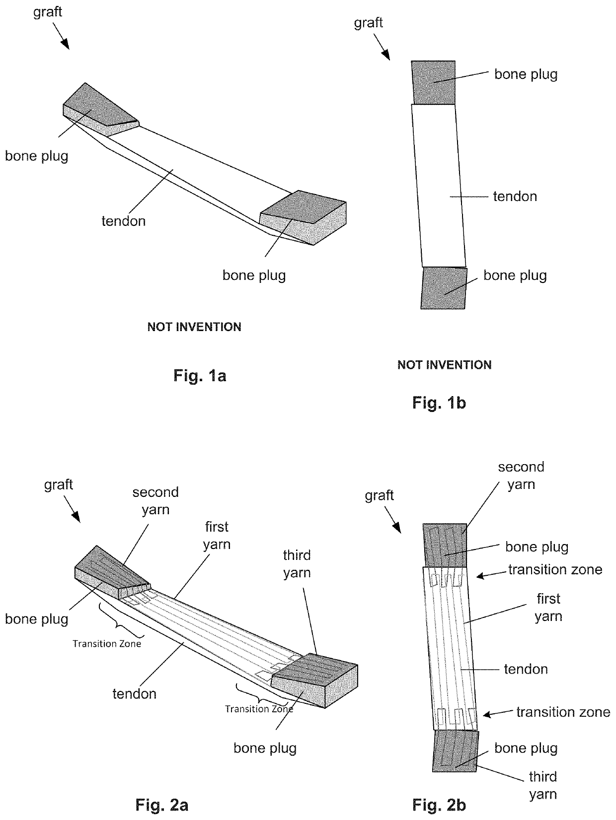 Reinforced Orthopedic devices