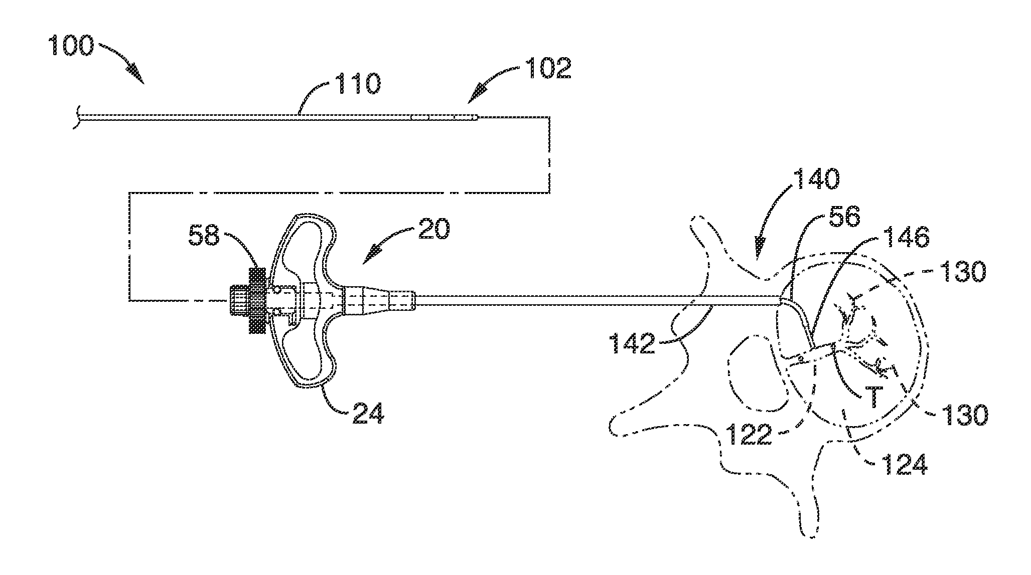 Basivertebral nerve denervation